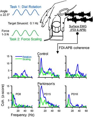 Parkinson's Disease Exhibits Amplified Intermuscular Coherence During Dynamic Voluntary Action